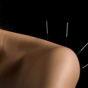 Acupuncture fees