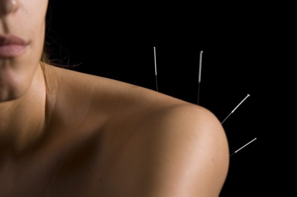 Acupuncture fees
